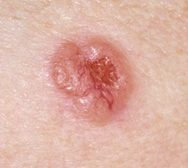 Carcinoma basocelular: qué es, síntomas, causas y cómo tratarlo