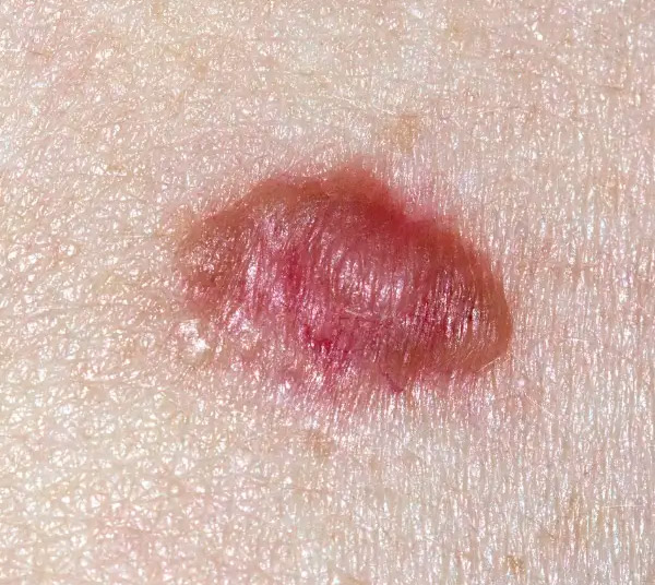 Carcinoma basocelular: qué es, síntomas, causas y cómo tratarlo