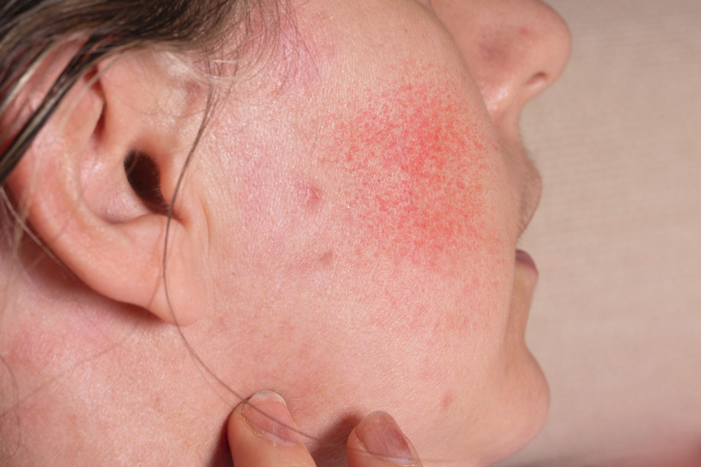 Descubre la rosácea síntomas, causas y tratamientos avanzados con la doctora y dermatóloga Leire Loidi en Pamplona