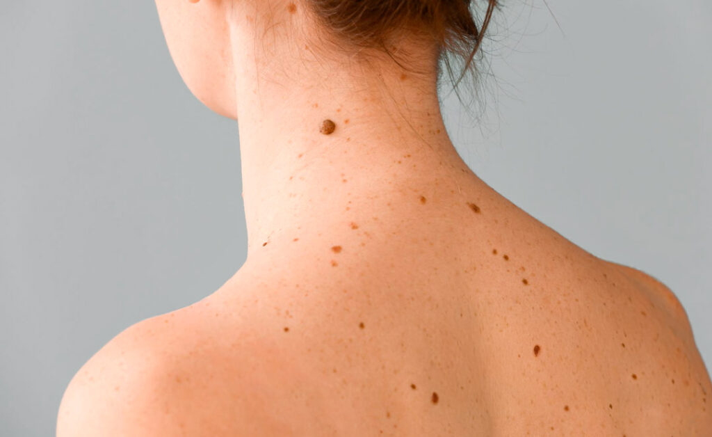 Nevus melanocíticos en Pamplona cuándo preocuparse y cómo tratarlos