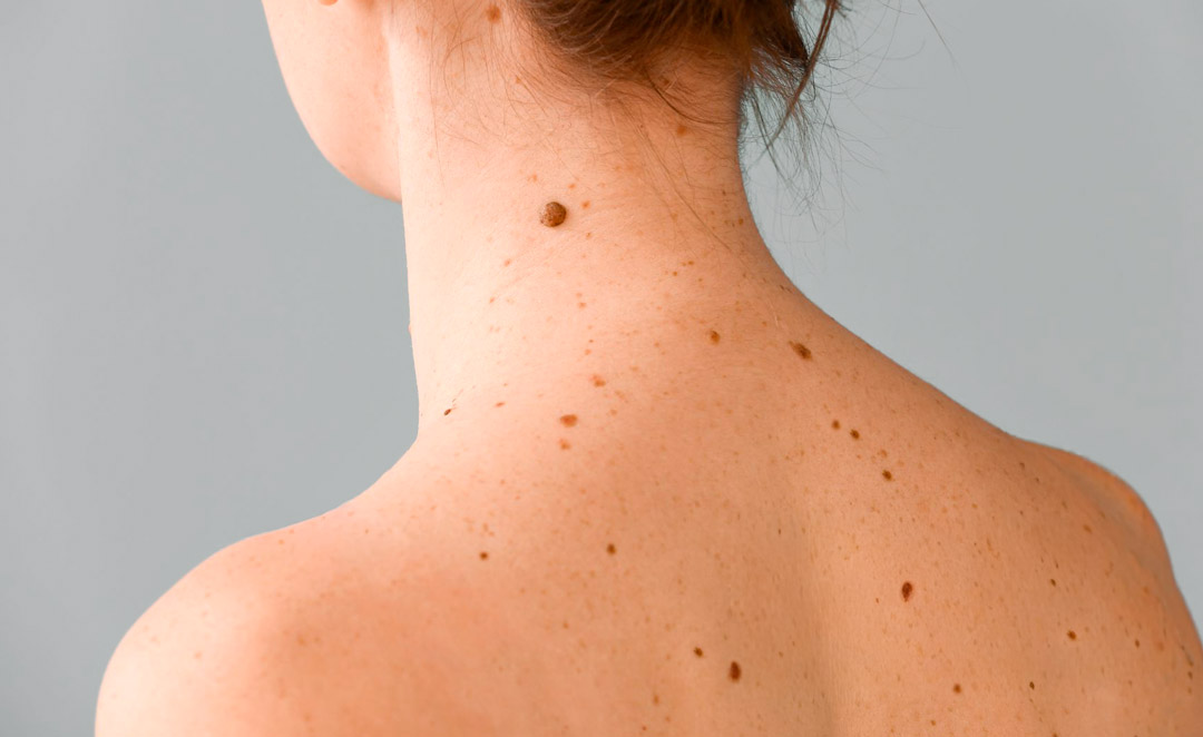 Nevus melanocíticos en Pamplona: cuándo preocuparse y cómo tratarlos
