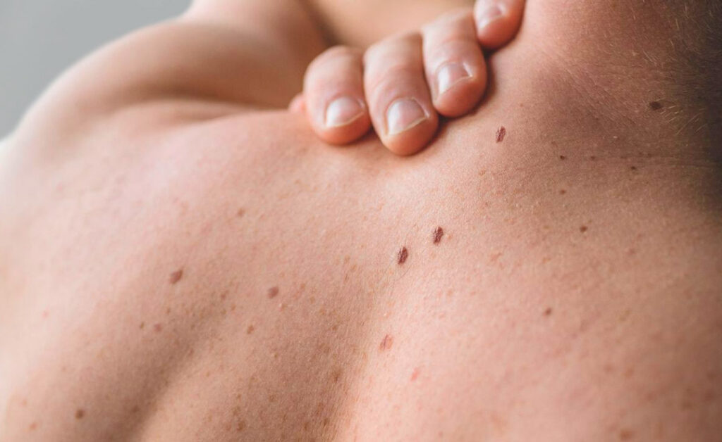 Nevus melanocíticos en Pamplona cuándo preocuparse y cómo tratarlos