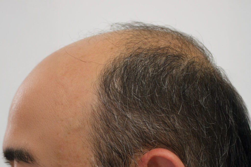 Alopecia androgénica causas, síntomas y tratamientos efectivos para recuperar tu cabello