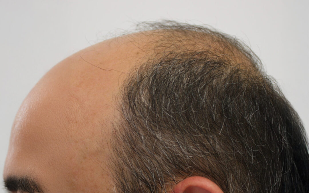 Alopecia androgénica: causas, síntomas y tratamientos efectivos para recuperar tu cabello